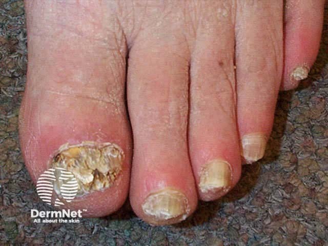 Total nail destruction due to fungal infection