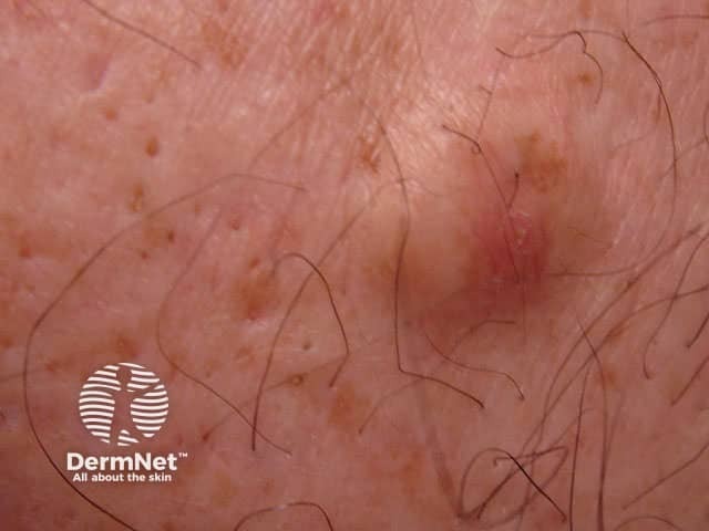 Acne cyst