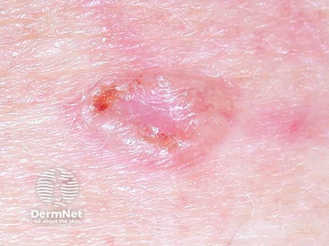 Basal cell carcinoma