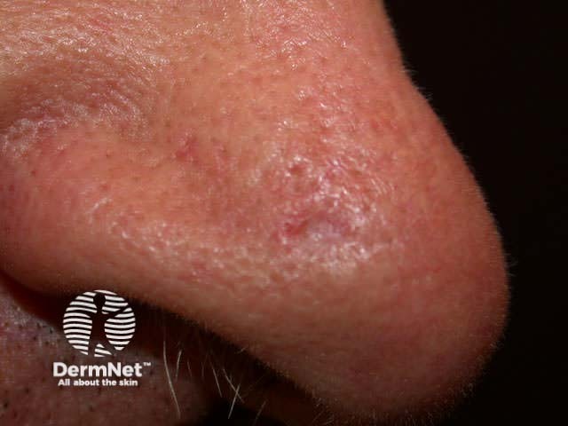 Basal cell carcinoma