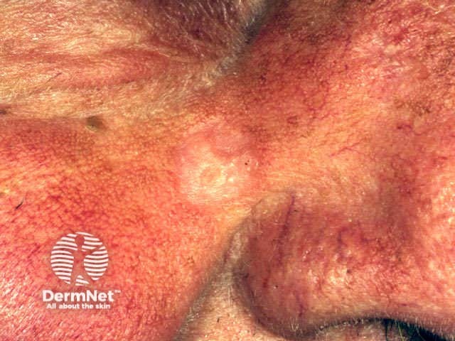 Basal cell carcinoma