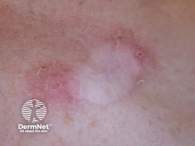 Basal cell carcinoma