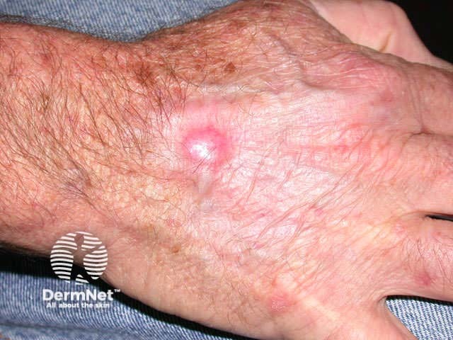 Basal cell carcinoma