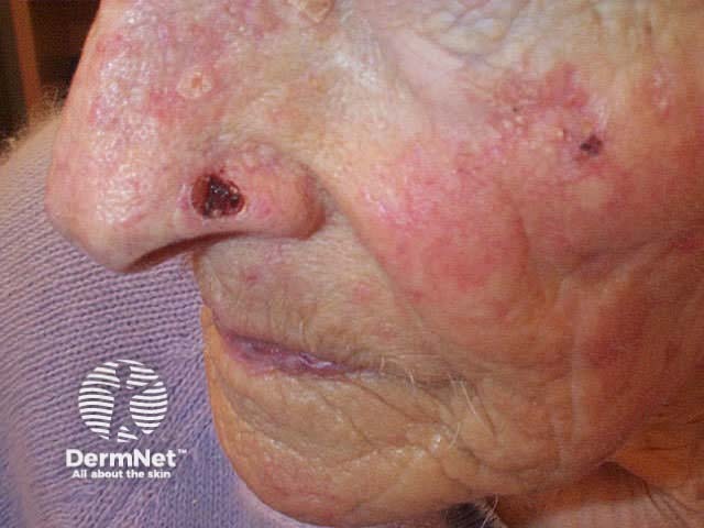 Basal cell carcinoma