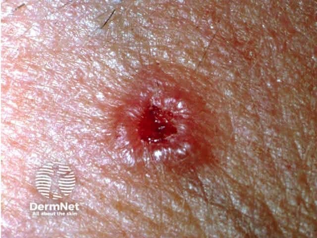 Basal cell carcinoma