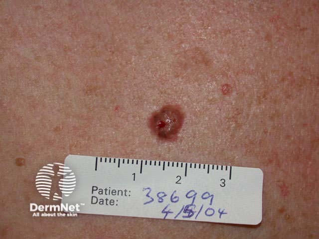 Basal cell carcinoma