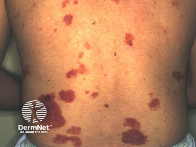 Basal cell carcinoma