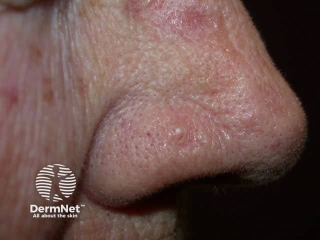 Basal cell carcinoma