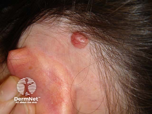 Basal cell carcinoma