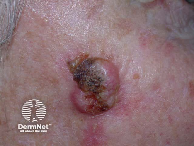 Basal cell carcinoma