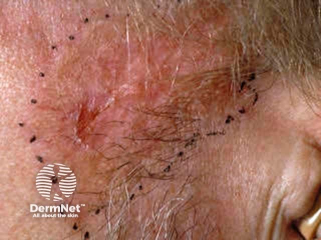 Basal cell carcinoma