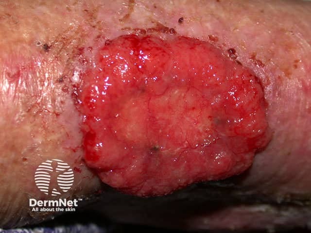 Basal cell carcinoma