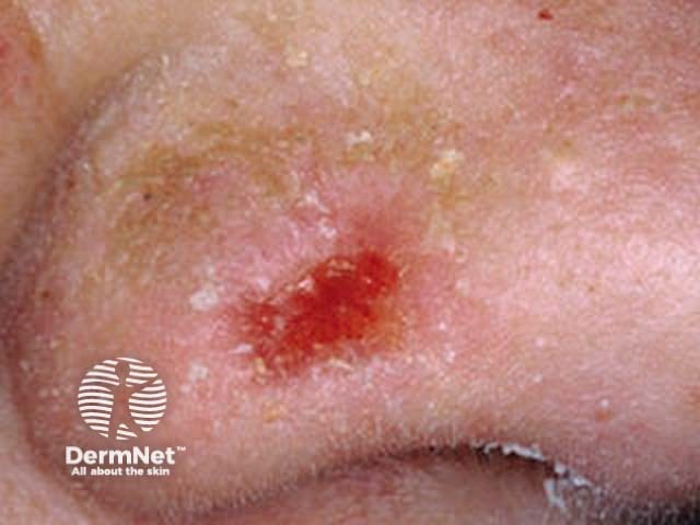 Basal cell carcinoma