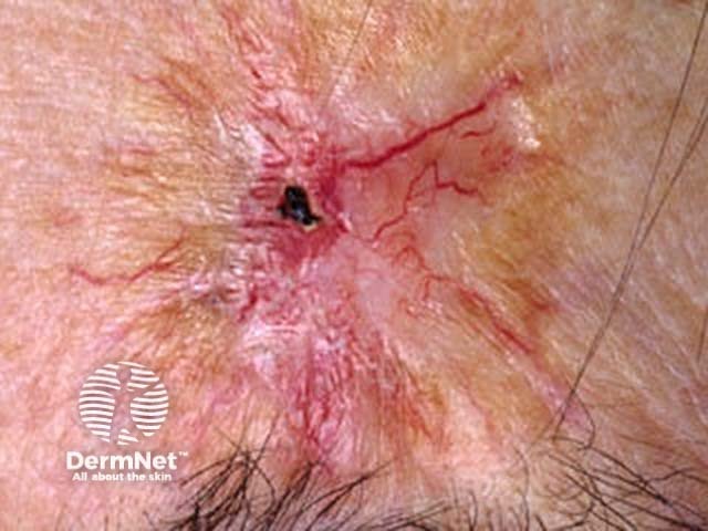 Basal cell carcinoma