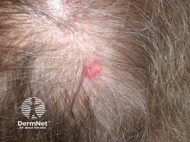 Basal cell carcinoma