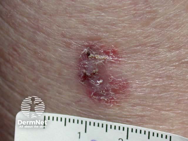 Basal cell carcinoma