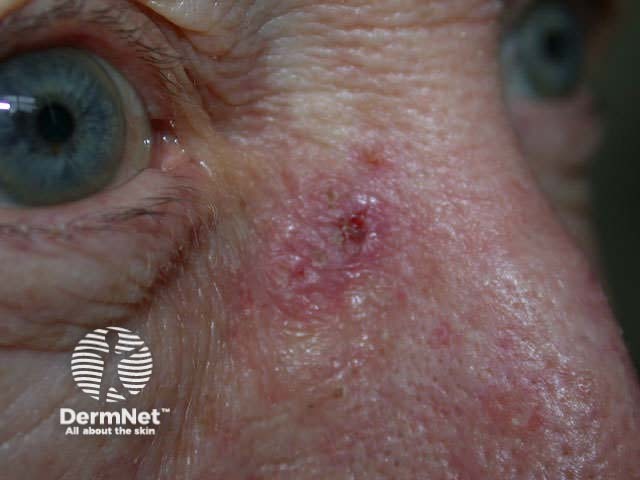 Basal cell carcinoma