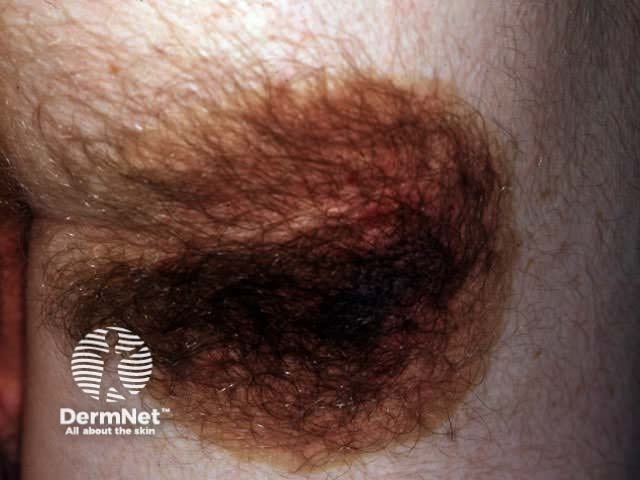 Medium hairy congenital melanocytic naevus