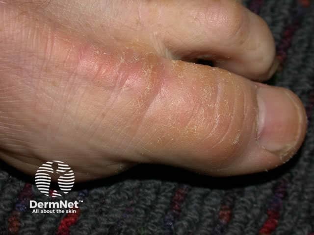 Callus from motorbike