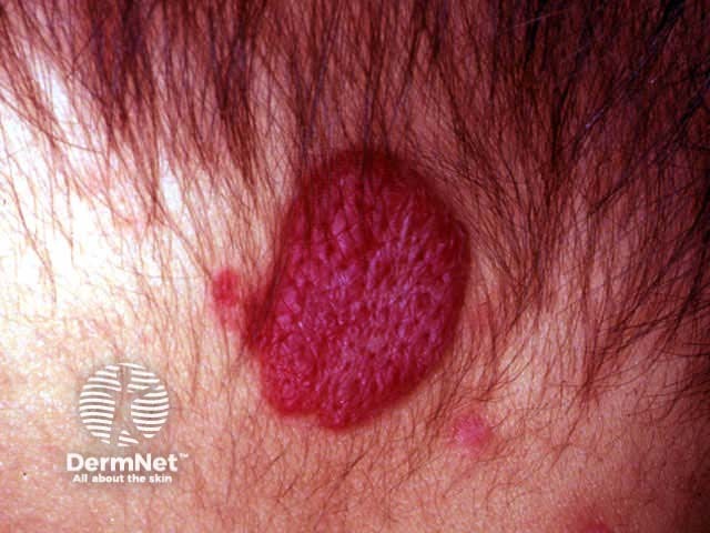 Superficial infantile haemangioma