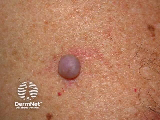 Cherry angioma