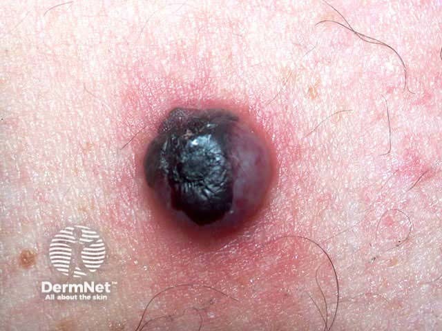 Cherry angioma