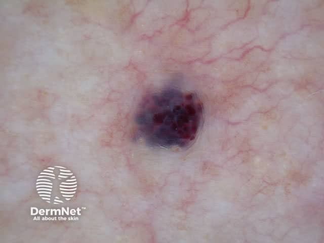 Cherry angioma