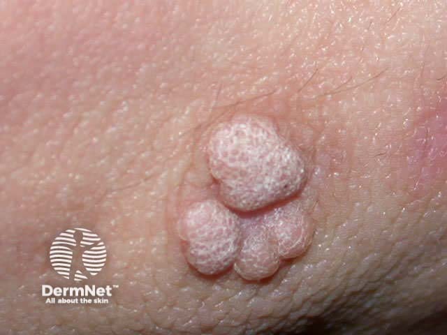 Viral warts