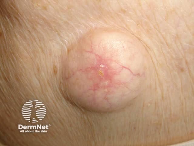 Epidermoid cyst