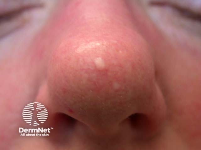 Fibrous papule of nose