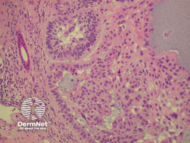 Histology of basal cell carcinoma