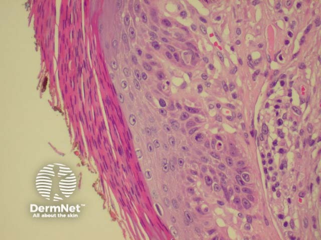 Actinic keratosis