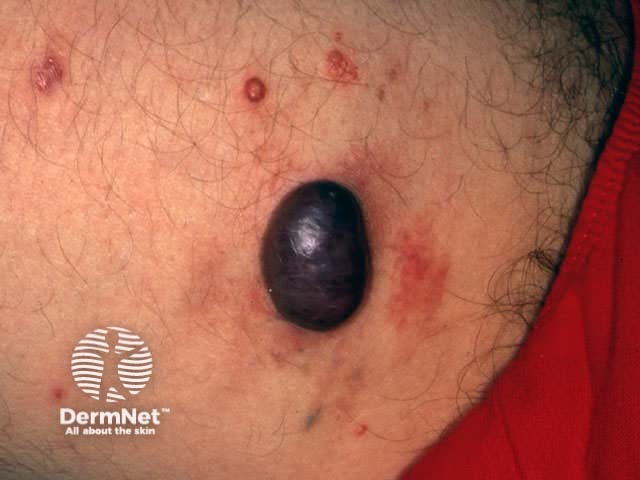 Kaposi sarcoma