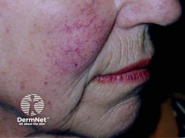 Facial telangiectasia