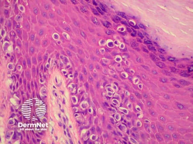 Acral lentiginous melanoma. Melanoma cells infiltrating up through epidermis. Note thick stratum cor