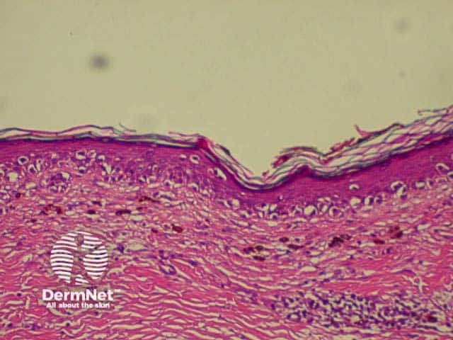 Lentigo maligna. Proliferation of abnormal melanocytes along the basal layer of a thinned, sun-damag