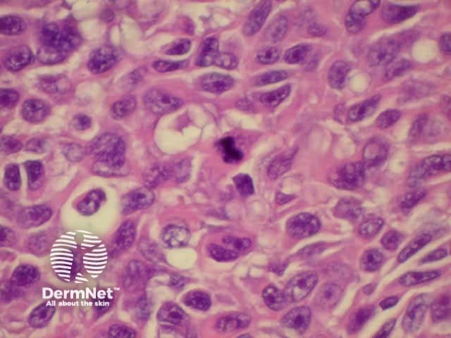 High power view of melanoma cells. Note mitosis in the centre of the image.