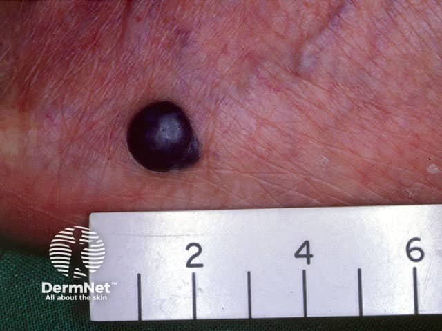 Nodular melanoma