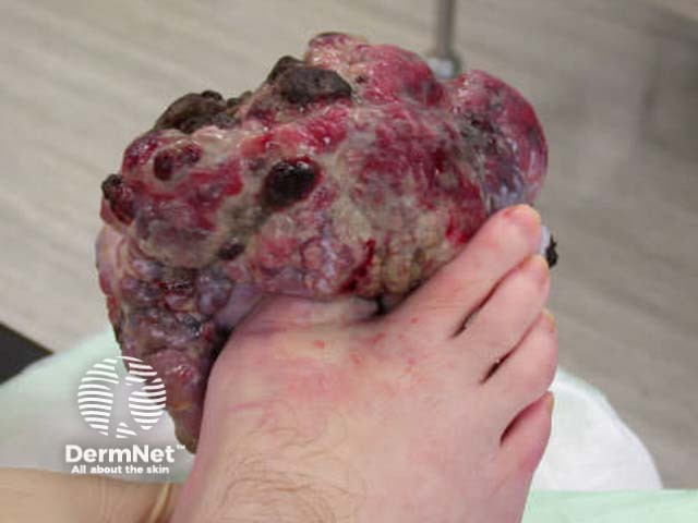 Neglected subungual melanoma