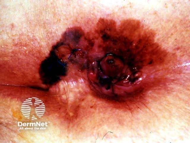 Anal melanoma