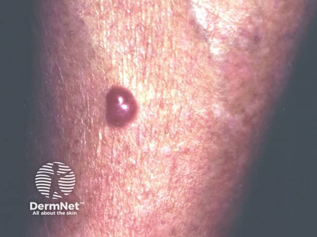 Merkel cell carcinoma