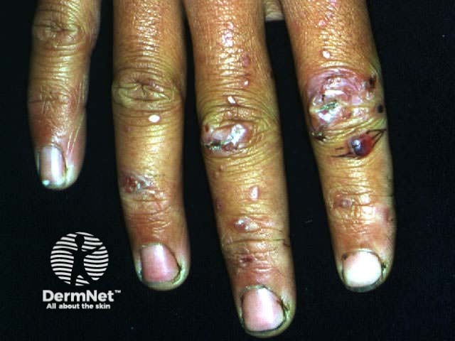 Epidermolysis bullosa