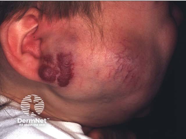 Mixed infantile haemangioma