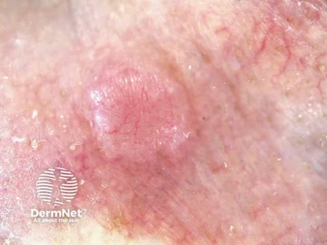 Basal cell carcinoma