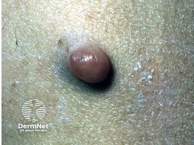 Neurofibroma