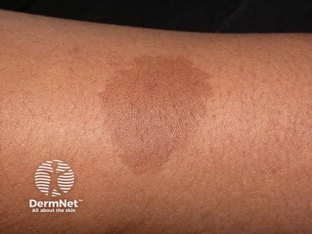 Neurofibroma