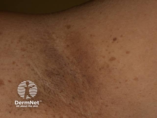 Neurofibroma