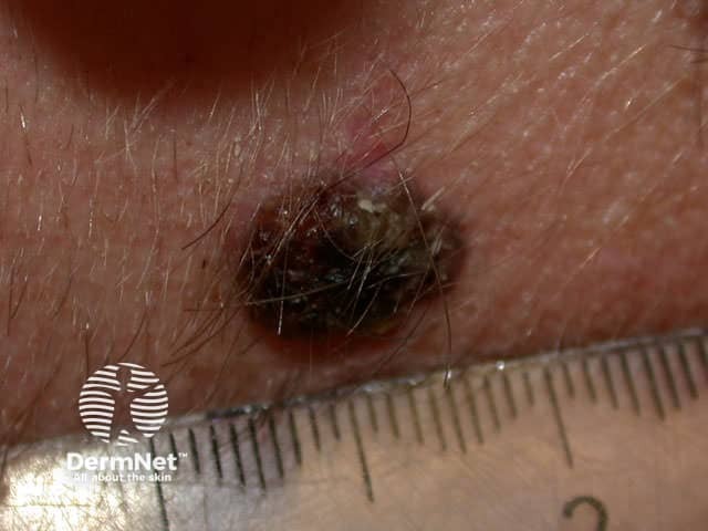 Ulcerated nodular melanoma