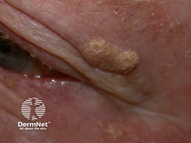 Seborrhoeic keratosis