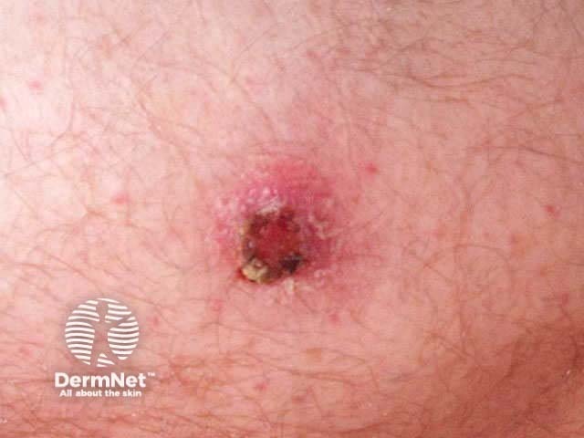 Irritated seborrhoeic keratosis